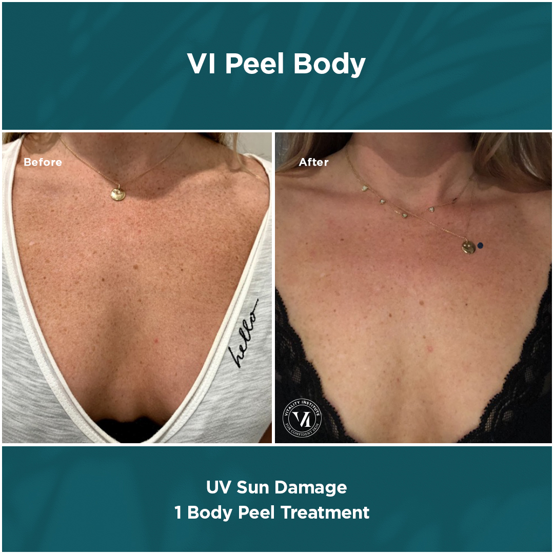 Chemical Peels
